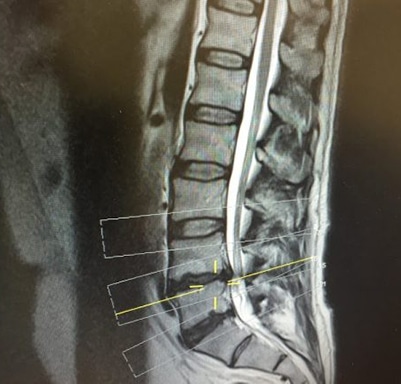 Spinal Compression X-Ray